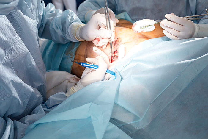 Chirurgie mammaire en salle d’opération